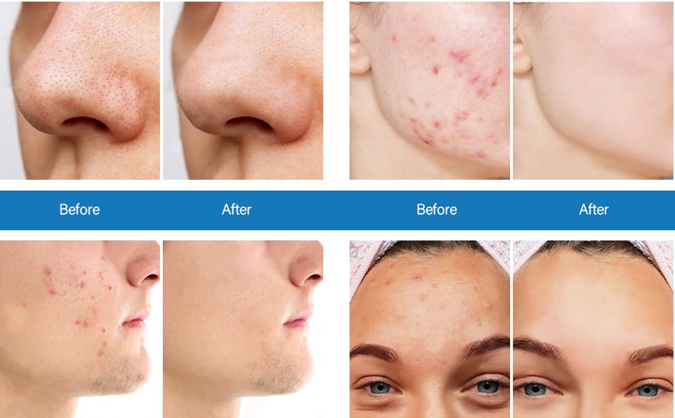 ClearCut Anti Acne Face Serum, Acne Mark Removal, 30 ml